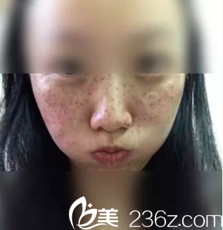 激光祛斑6天后結(jié)痂 激光祛斑6天后結(jié)痂