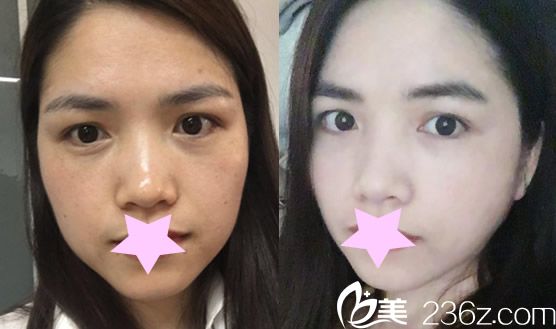 去合肥華美整形超皮秒祛斑前后治療<span style= 去合肥華美整形超皮秒祛斑前后治療<span style=