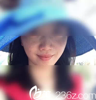 術(shù)前雀斑嚴(yán)重 術(shù)前雀斑嚴(yán)重