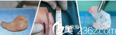 自體軟骨隆鼻的材料