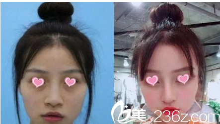 學(xué)生妹做的鼻綜合案例