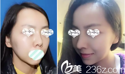 寶媽不滿意鼻尖做的修復(fù)