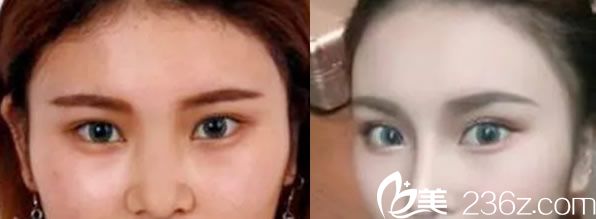 田秋梅醫(yī)生鼻綜合代表案例 田秋梅醫(yī)生鼻綜合代表案例