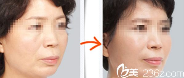 胡慶旭醫(yī)生面部除皺前后效果對比圖 胡慶旭醫(yī)生面部除皺前后效果對比圖