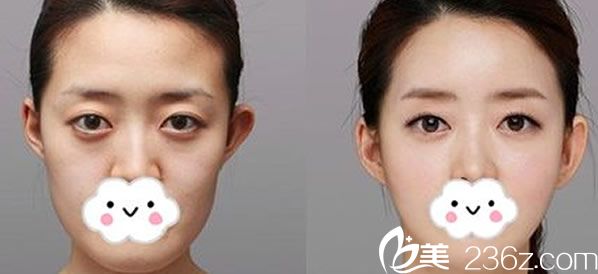 薇琳整形醫(yī)院V臉提升案例賞析 薇琳整形醫(yī)院V臉提升案例賞析