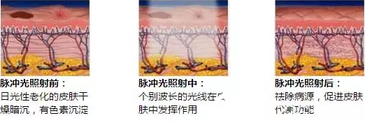 彩光嫩膚工作原理