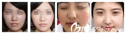 彩光嫩膚真人案例