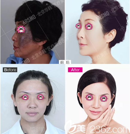 激光美容、微整抗衰“雙神手”虞守輝院長(zhǎng)經(jīng)典案例