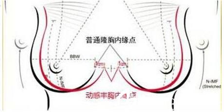  假體隆胸術(shù)后能安全取出？