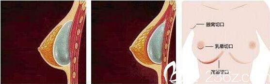  隆胸假體取出后護理事項：