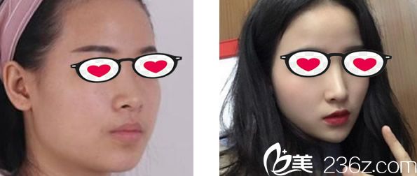 酒泉華美鼻綜合隆鼻前后對比圖 酒泉華美鼻綜合隆鼻前后對比圖