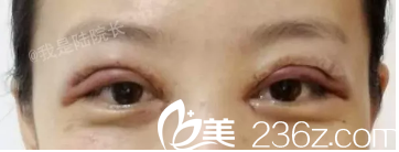 眼睛就像是被蜜蜂蟄了一樣