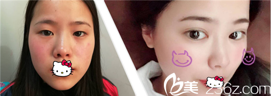 成都西區(qū)醫(yī)院車紅昌做雙眼皮好嗎？真實案例效果展示