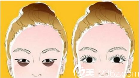 激光去黑眼圈不適合哪些人？