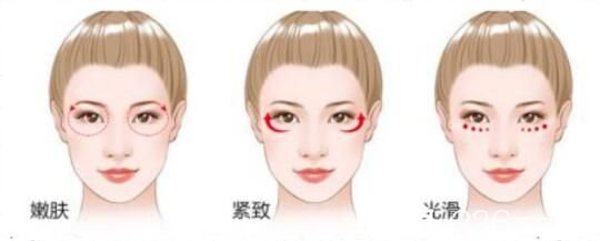  激光去黑眼圈副作用
