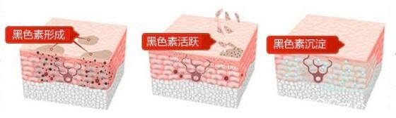 激光去黑眼圈需要注意事項