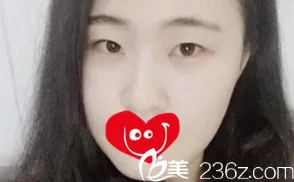 割雙眼皮術(shù)前照 割雙眼皮術(shù)前照