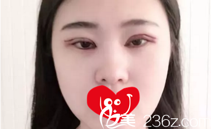 割雙眼皮術(shù)后第二天效果 割雙眼皮術(shù)后第二天效果