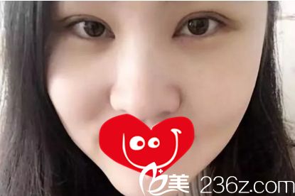 割雙眼皮術(shù)后第5天時(shí)的效果 割雙眼皮術(shù)后第5天時(shí)的效果