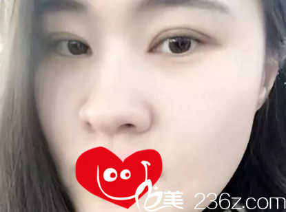 在大連個(gè)雙眼皮術(shù)后半個(gè)月效果 在大連個(gè)雙眼皮術(shù)后半個(gè)月效果