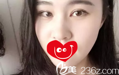 在大連新華美天做雙眼皮第22天效果 在大連新華美天做雙眼皮第22天效果