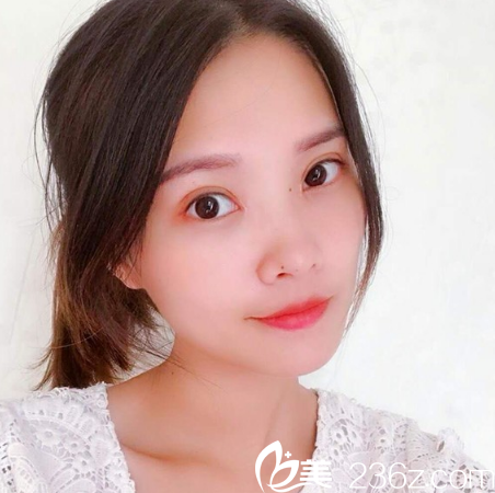 在廣州天姿整形醫(yī)院做完雙眼皮一個月自拍 在廣州天姿整形醫(yī)院做完雙眼皮一個月自拍