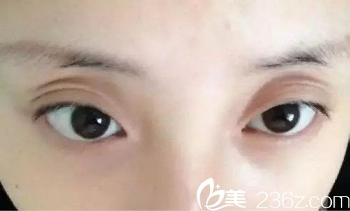 雙眼皮不對(duì)稱