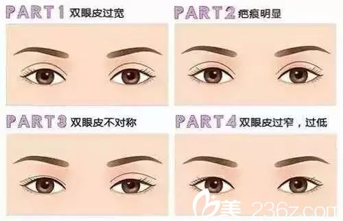 在哪些情況下需要做雙眼皮修復(fù)手術(shù)