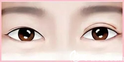 雙眼皮修復(fù)手術(shù)較多能做幾次