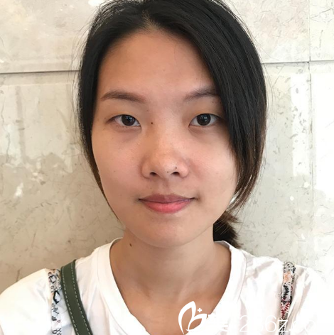 在廣州天姿整形醫(yī)院做雙眼皮手術(shù)前 在廣州天姿整形醫(yī)院做雙眼皮手術(shù)前