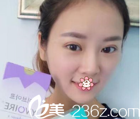 新疆黎美整形做雙眼皮怎么樣 新疆黎美整形做雙眼皮怎么樣