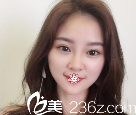 許黎做雙眼皮效果怎么樣 許黎做雙眼皮效果怎么樣