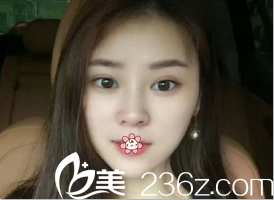 一年了，我把自己在新疆黎美整形許黎那兒做的6.5mm雙眼皮術后恢復過程寫了下來