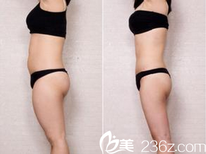 成都西區(qū)醫(yī)院全身吸脂案例對比照 成都西區(qū)醫(yī)院全身吸脂案例對比照