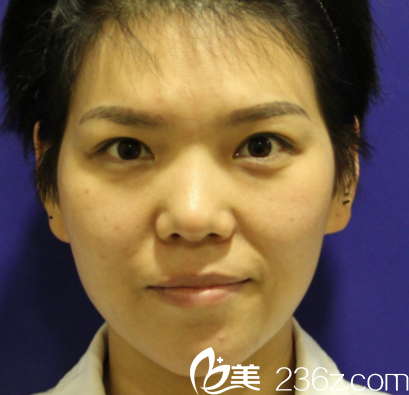 這是做鼻綜合之前的我 這是做鼻綜合之前的我