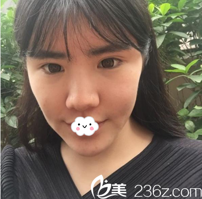 全臉脂肪填充+鼻尖整形術(shù)前照 全臉脂肪填充+鼻尖整形術(shù)前照