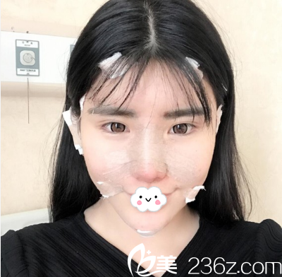 成都市西區(qū)醫(yī)院鄧東偉自體脂肪填充面部術(shù)后即刻 成都市西區(qū)醫(yī)院鄧東偉自體脂肪填充面部術(shù)后即刻