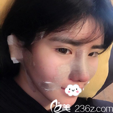 鄧東偉面部脂肪填充+鼻尖整形術(shù)后側(cè)臉照 鄧東偉面部脂肪填充+鼻尖整形術(shù)后側(cè)臉照