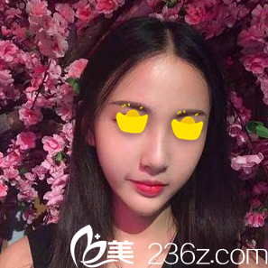 注射術(shù)后一周效果 注射術(shù)后一周效果