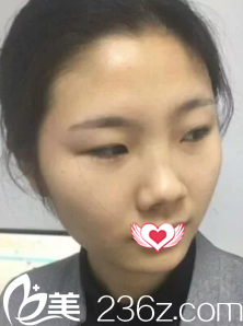 術前塌鼻梁大鼻頭 術前塌鼻梁大鼻頭