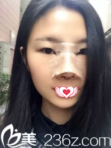 剛做完鼻子腫脹厲害 剛做完鼻子腫脹厲害