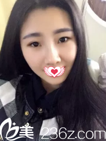 術后7天鼻子拆線后微腫 術后7天鼻子拆線后微腫