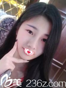 我想要的自然小翹鼻效果 終于找訾海濤醫(yī)生做完鼻綜合手術(shù)實(shí)現(xiàn)