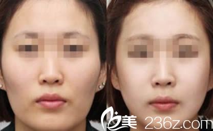 南京維多利亞自體脂肪面部填充案例對比圖 南京維多利亞自體脂肪面部填充案例對比圖