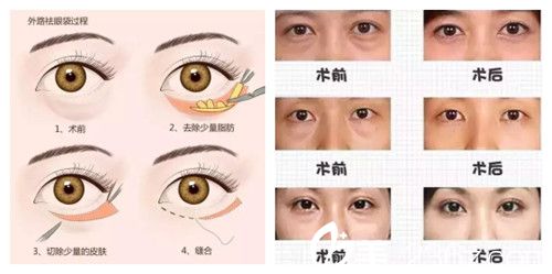微創(chuàng)去眼袋手術(shù)案例