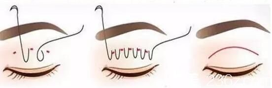 埋線雙眼皮好嗎？