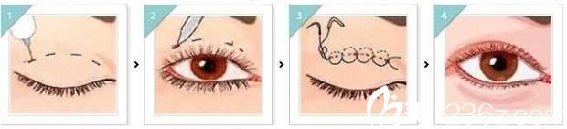 埋線雙眼皮術(shù)后注意事項(xiàng)