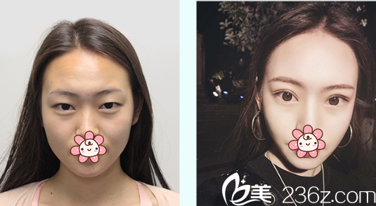 成都艾米麗孫歡雙眼皮案例效果展示 成都艾米麗孫歡雙眼皮案例效果展示