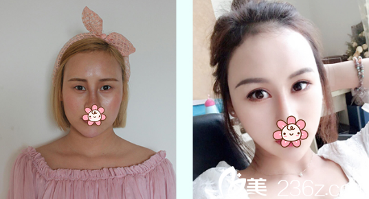 孫歡雙眼皮+開外眼角術(shù)前術(shù)后對比照片 孫歡雙眼皮+開外眼角術(shù)前術(shù)后對比照片