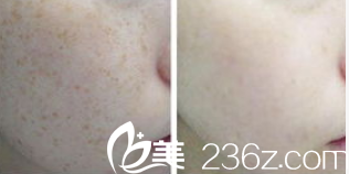 宋開濤醫(yī)生祛斑案例 宋開濤醫(yī)生祛斑案例